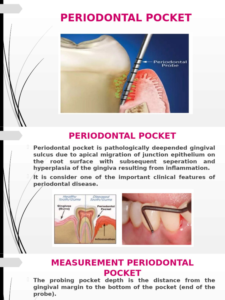 Periodontal Pocket and Abscess Overview | PDF | Periodontology ...