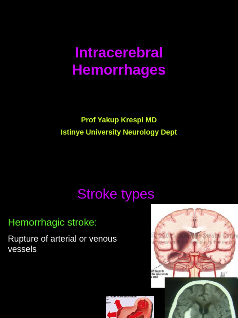 Intracerebral Hemorrhage Overview | PDF | Stroke | Neurological Disorders