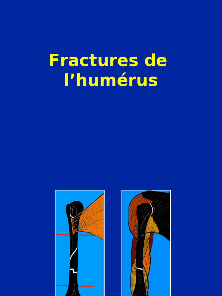 Fractures de l'humérus : traitement et complications | PDF | Système ...