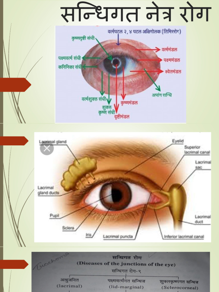 Sandhigat Netra Roga | PDF