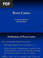 Root Caries