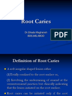 Root Caries