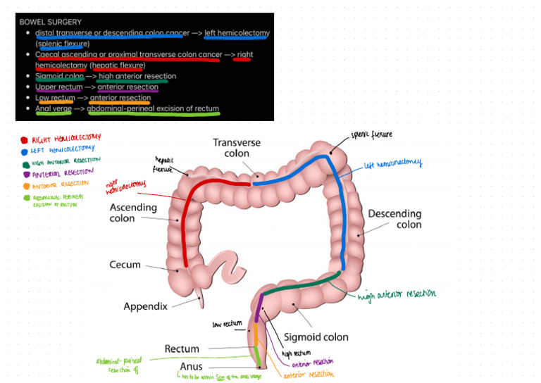 Hemicolectomy and Resection Types | PDF