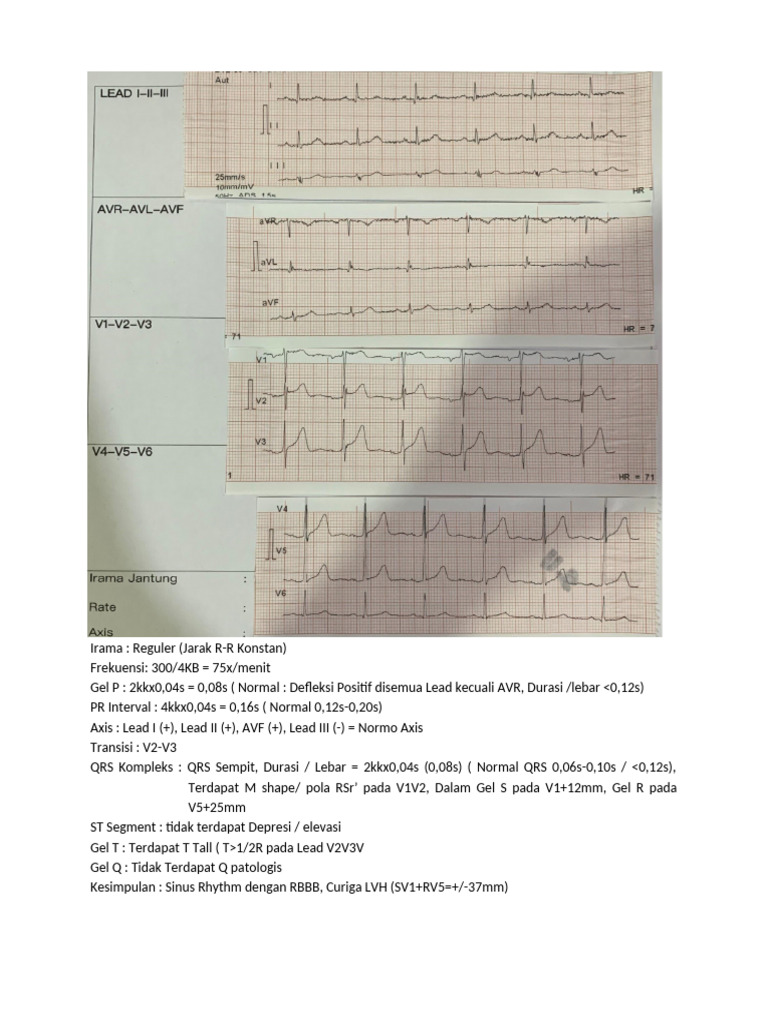 Sinus Rhythm dengan RBBB dan LVH | PDF
