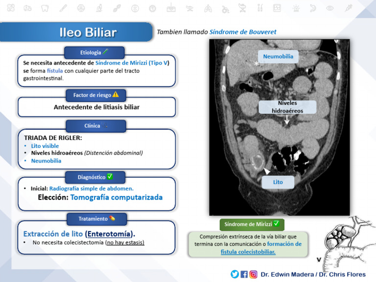 Ileo Biliar y Síndrome de Mirizzi | PDF