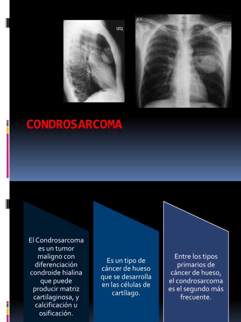 Condrosarcoma