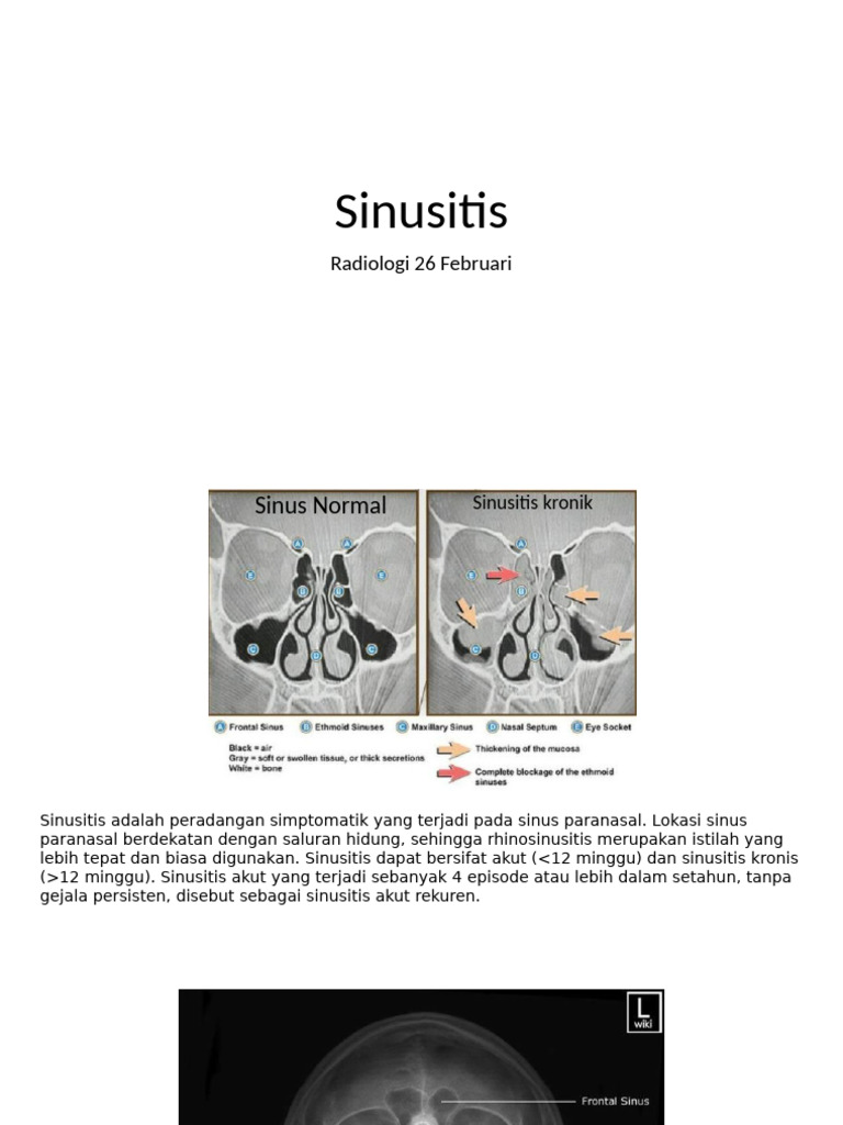 Sinusitis Afif | PDF