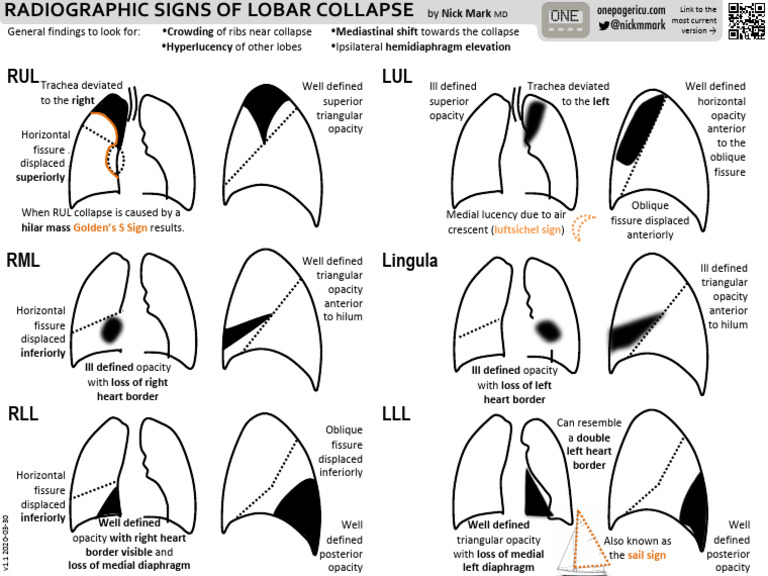 Radiographic Signs of Lobar Collapse | PDF | Thorax (Human Anatomy ...