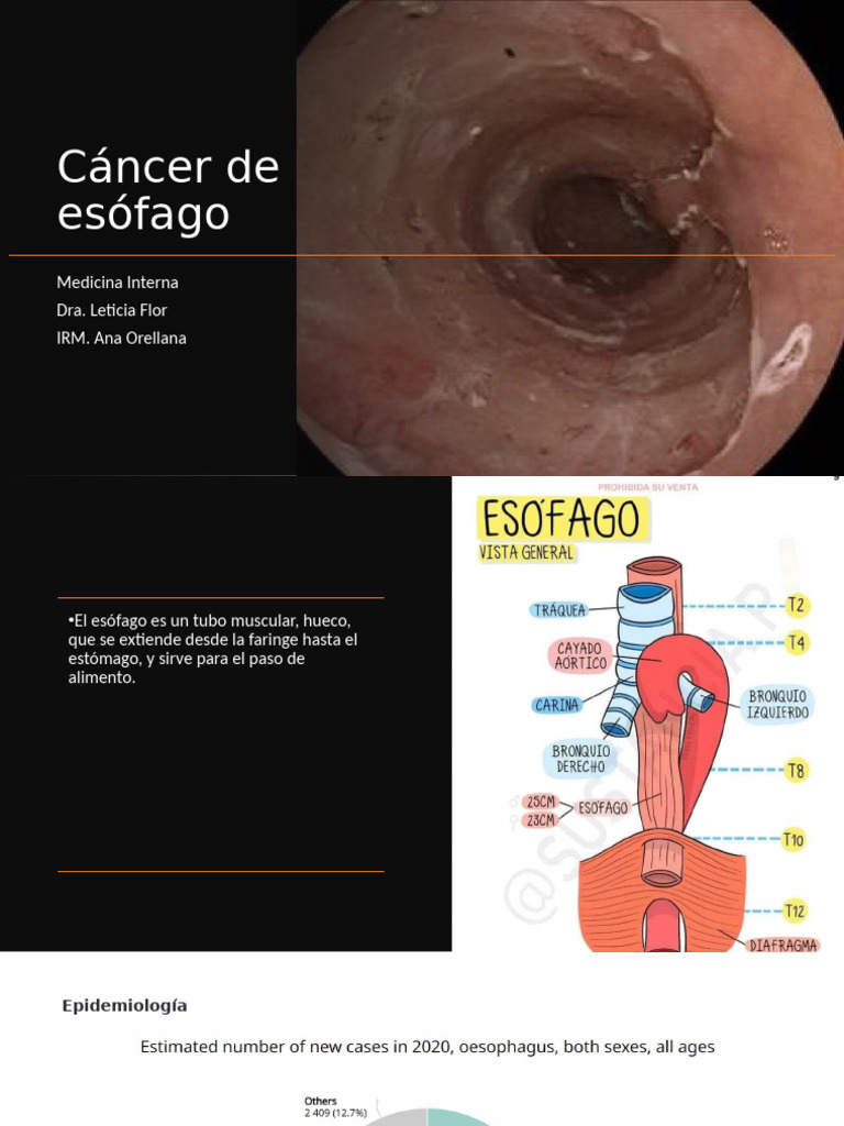 Cáncer de esófago: epidemiología y síntomas | PDF | Cáncer de esófago ...
