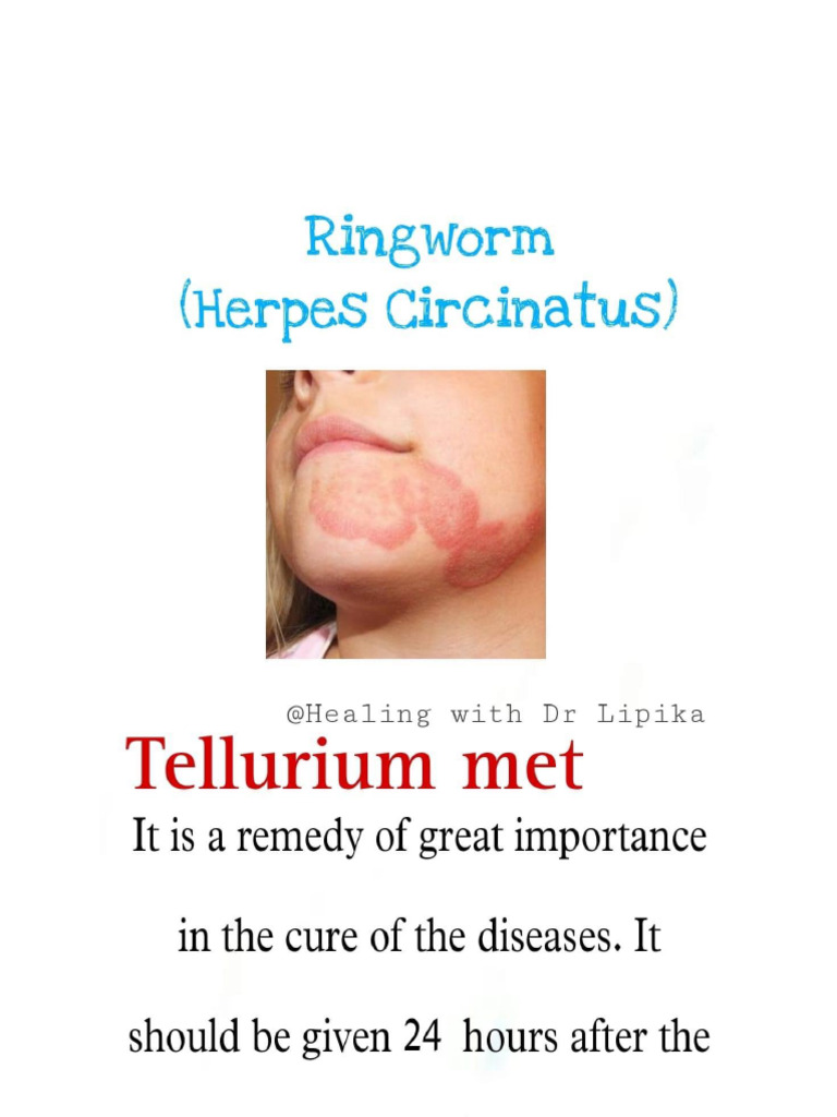 Ringworm | PDF