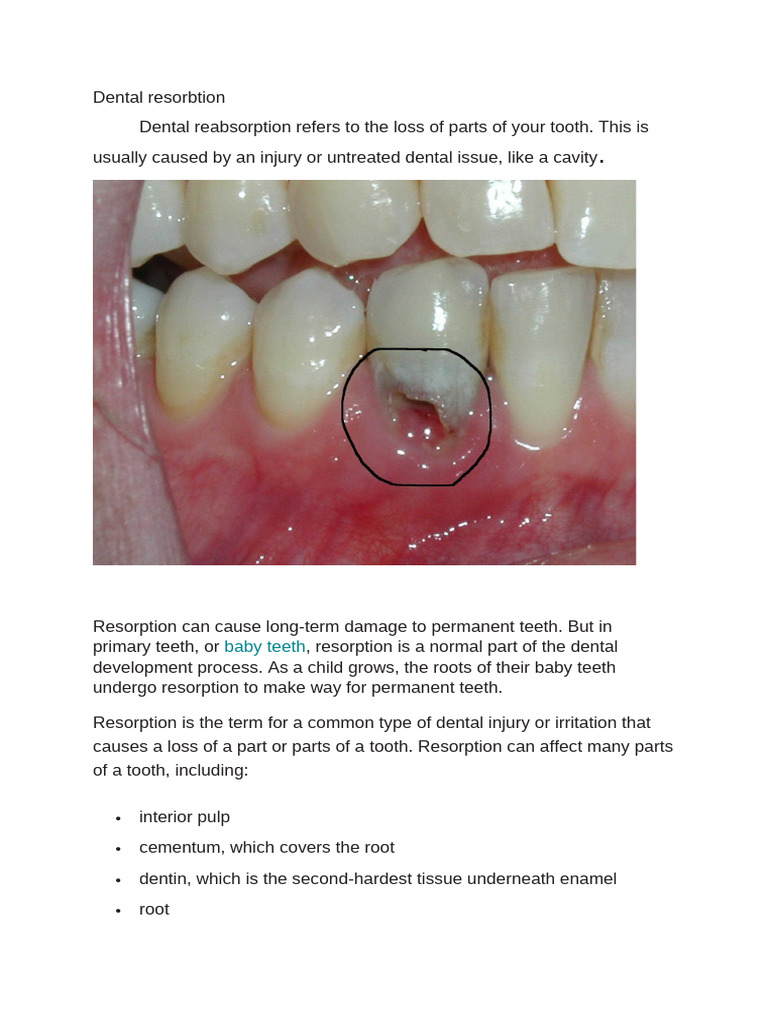3.7resobtion of Teeth | PDF | Human Tooth | Dentistry Branches
