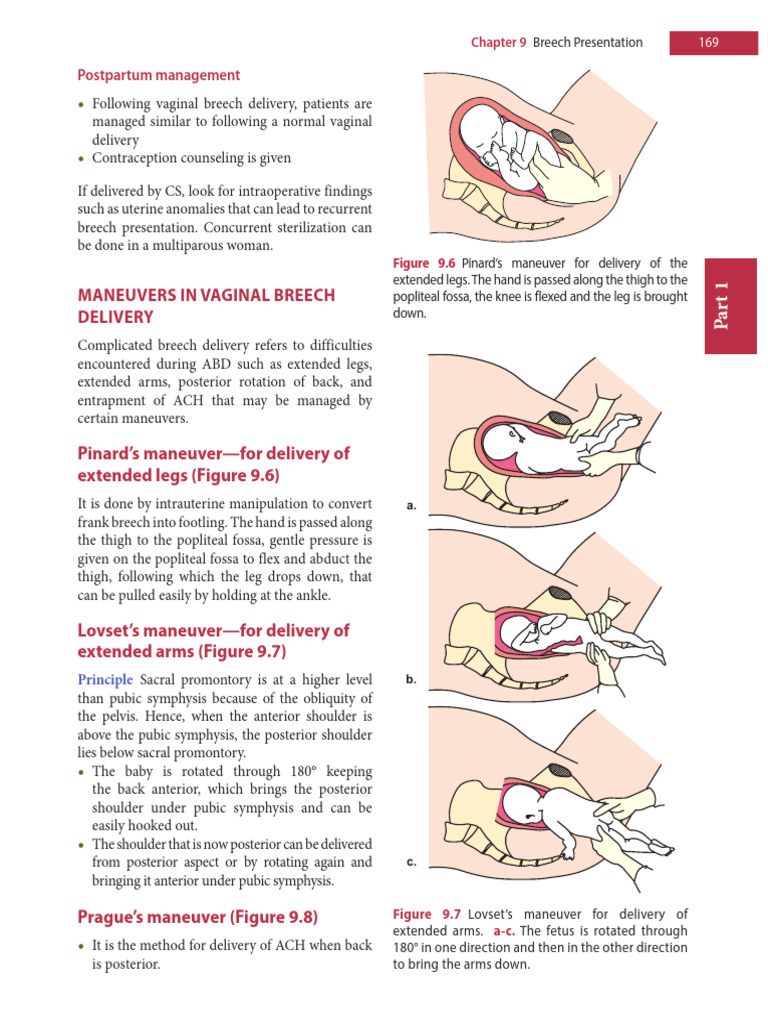 Breech Delivery Maneuvers Explained | PDF | Childbirth | Medical ...