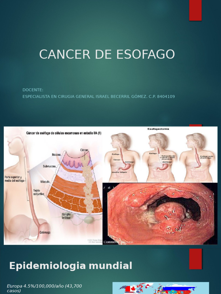 Cancer de Esofago 2 | PDF | Cáncer | Biopsia