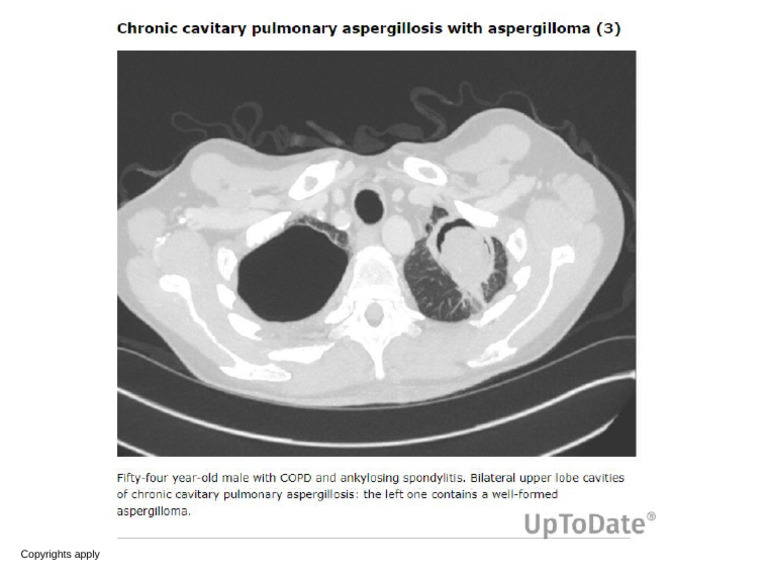 Chronic Cavitary Pulmonary Aspergillosis With Aspergilloma 3 | PDF