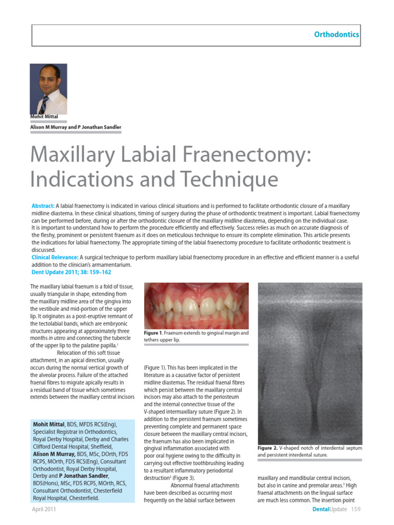 Maxillary Labial Fraenectomy Guide | PDF | Orthodontics | Dentistry ...