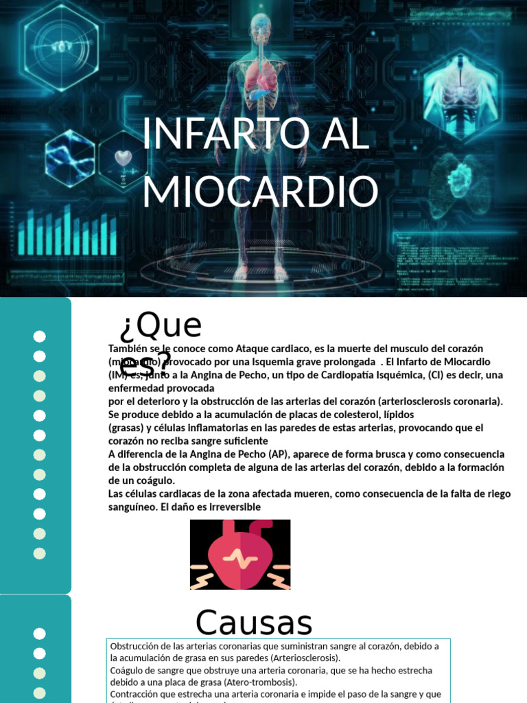 Infarto de Miocardio: Causas y Síntomas | PDF