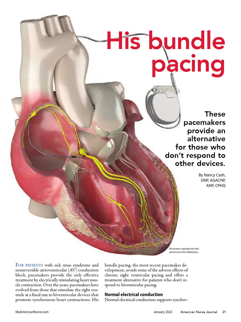 His Bundle Pacing: A New Alternative | PDF | Heart | Atrium (Heart)
