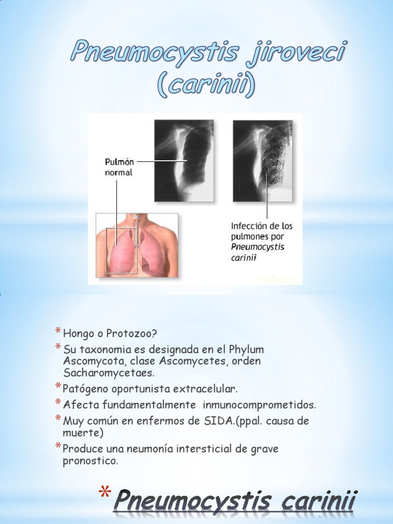 Pneumocystis Jiroveci PDF Neumonía Medicina