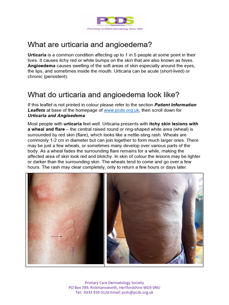 Urticaria PIL Dec 23 For PDF | PDF | Allergy | Cutaneous Conditions
