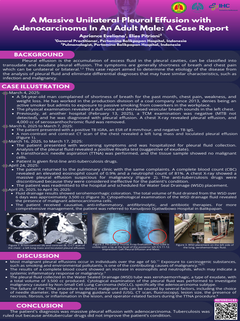 A Massive Unilateral Pleural Effusion With Adenocarcinoma in An Adult ...