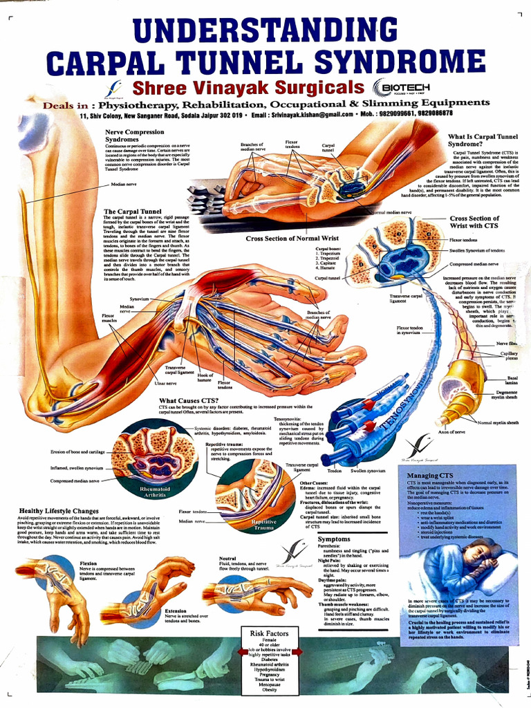 Carpal Tunnel Syndrome Explained | PDF | Carpal Tunnel Syndrome | Hand