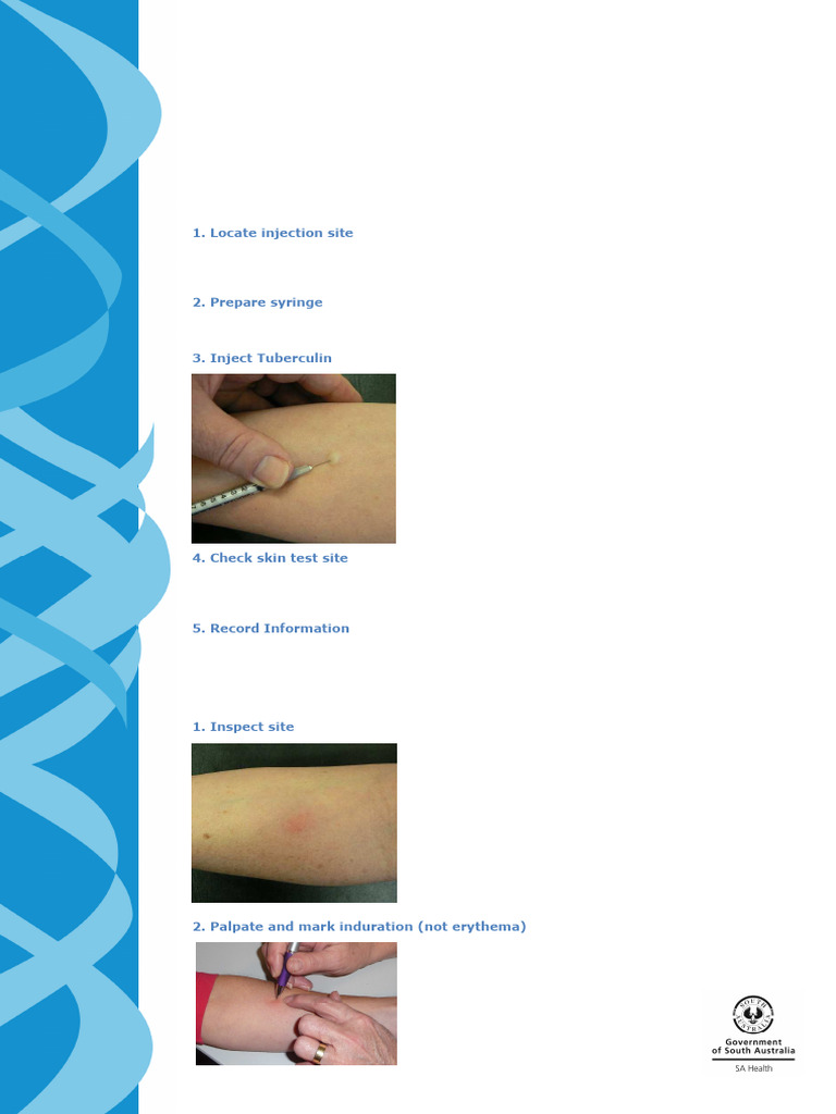 Tuberculin Skin Test - Administration Fact Sheet SATBS 20180227 | PDF ...