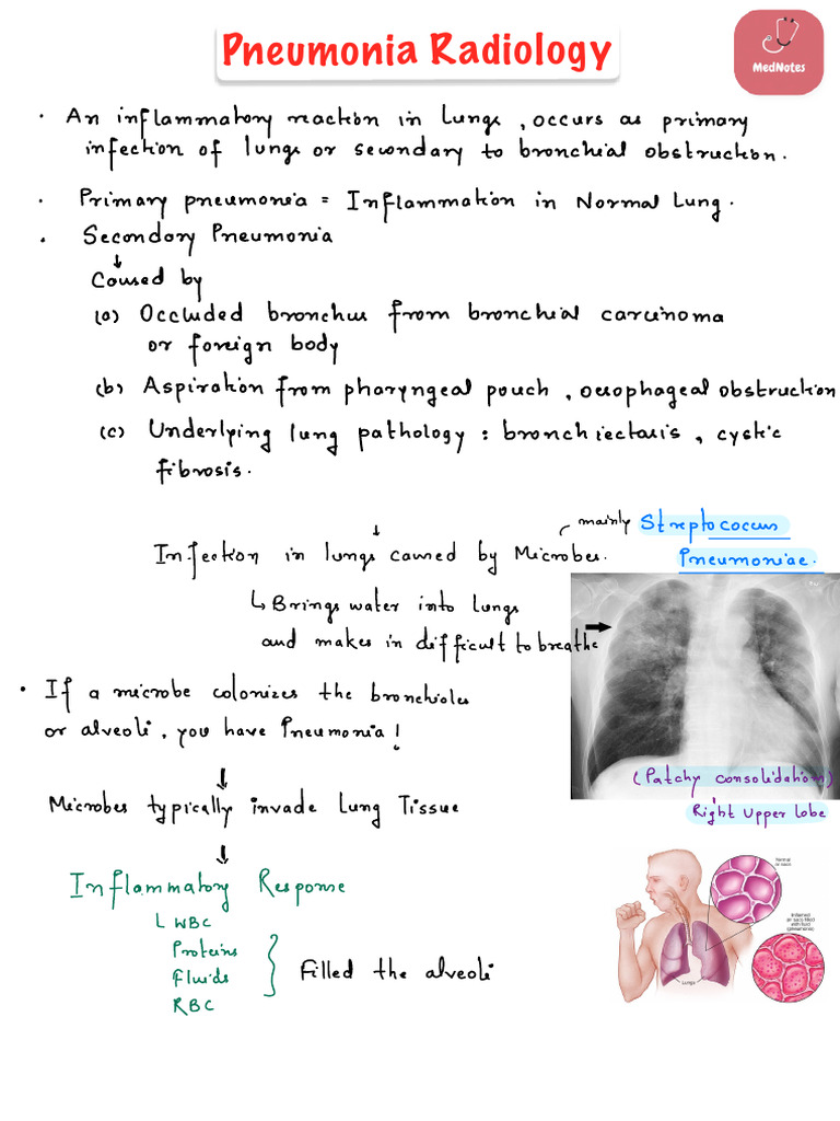 Pneumonia Radiology | PDF | Pneumonia | Lung