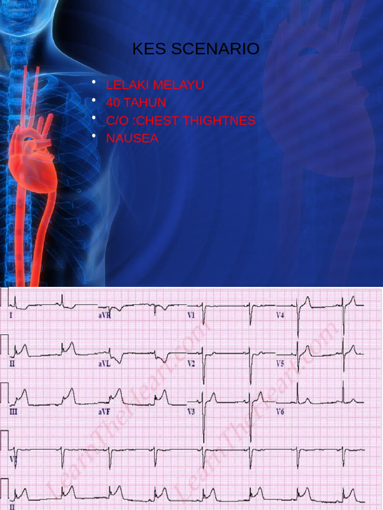 Myocardial Infarction Overview in Malay | PDF | Myocardial Infarction ...