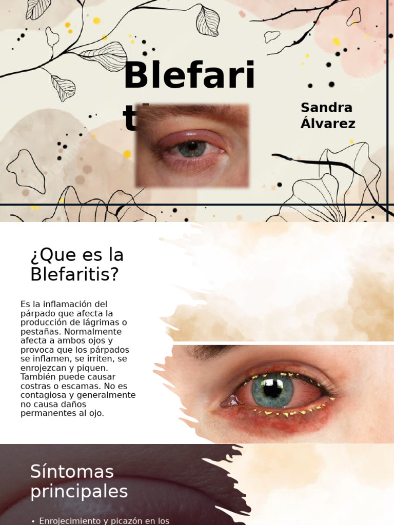 Blefaritis: Síntomas y Tratamientos | PDF