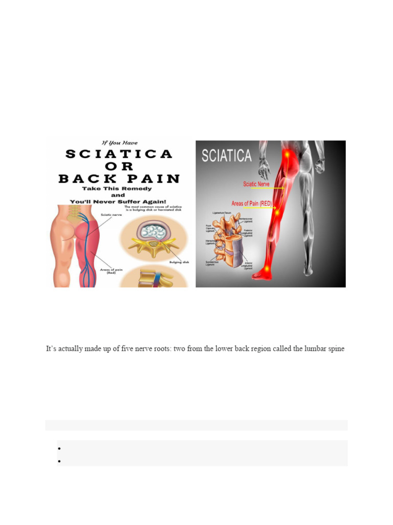 Understanding Sciatica Symptoms and Causes | PDF