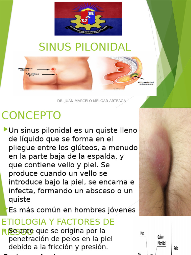 Manejo del Sinus Pilonidal | PDF | Especialidades Medicas ...