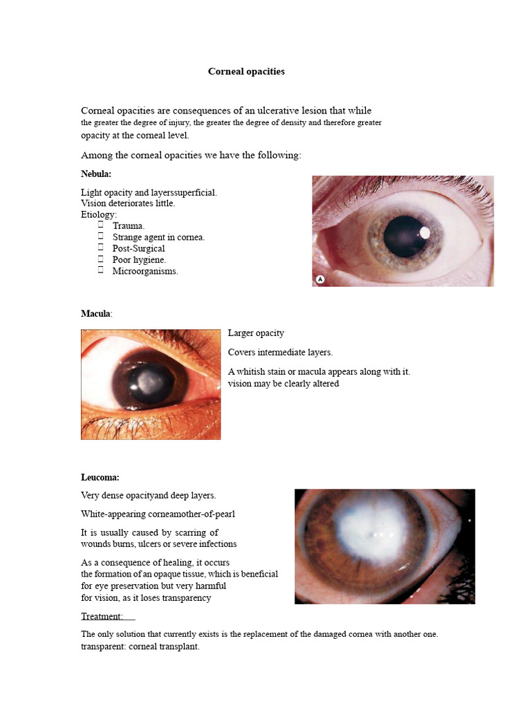 Understanding Corneal Opacities | PDF | Cornea | Medical Specialties