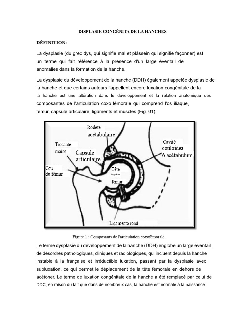 Dysplasie congénitale de la hanche : définition et anatomie | PDF ...