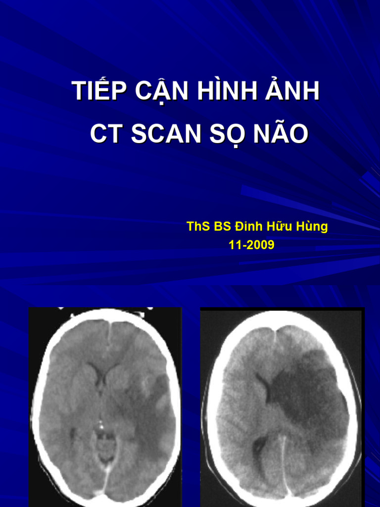 CT Scan So Nao Ths Bs Dinh Huu Hung | PDF