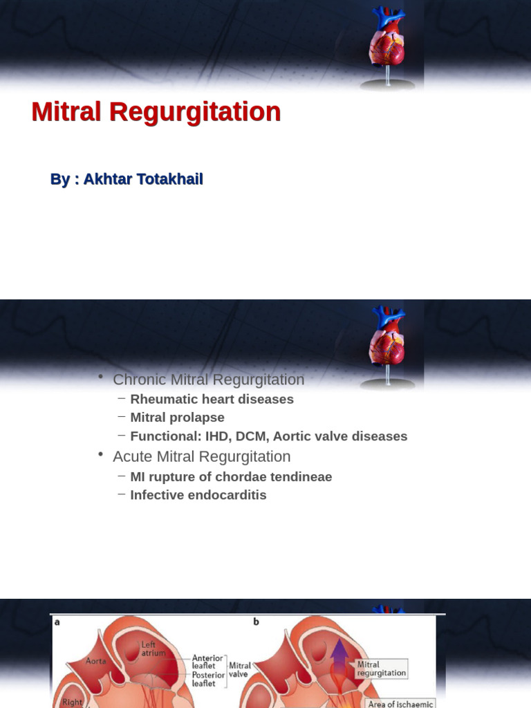 Understanding Mitral Regurgitation Symptoms and Management | PDF
