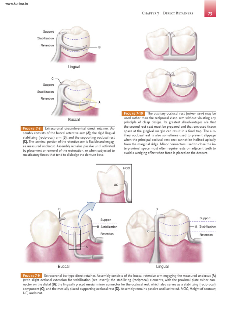 Reciprocal Arm in Direct Retainers | PDF | Tooth | Dental Anatomy