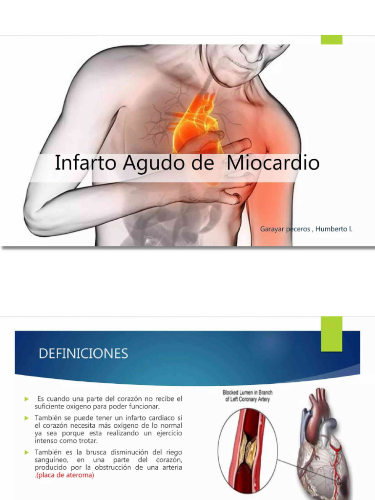 Infarto Agudo de Miocardio (IAM) | PDF
