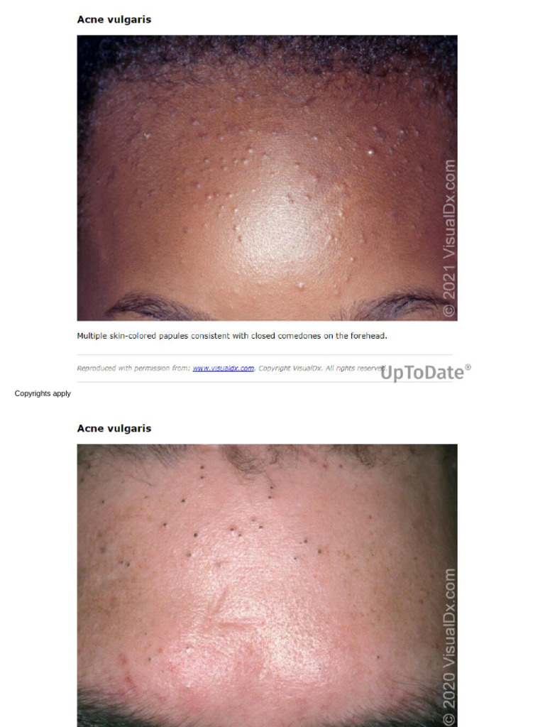 Acne Vulgaris Closed Comedones | PDF