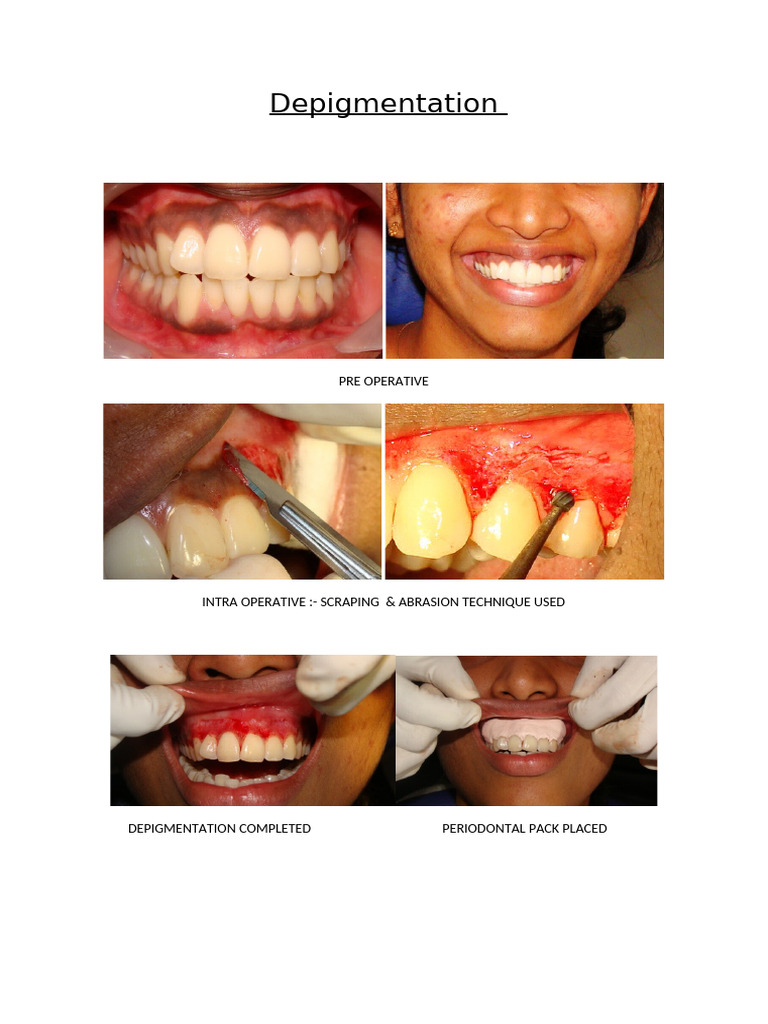 Depigmentation Procedure Overview | PDF