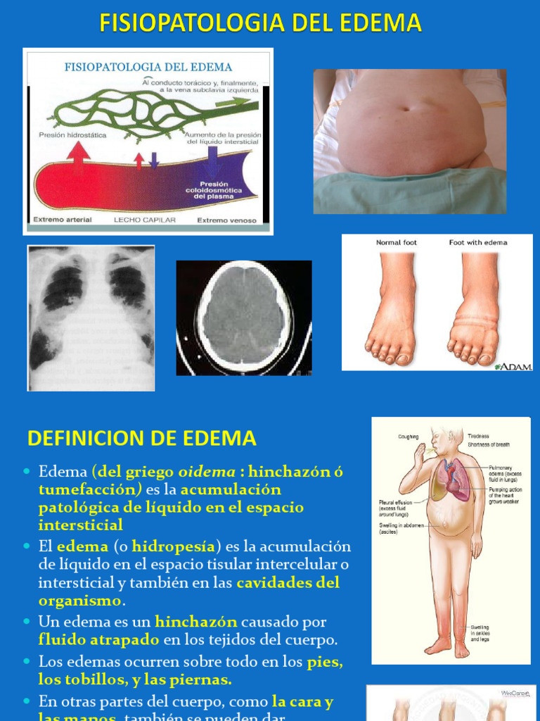 Definición y Tipos de Edema Médico | PDF | Edema | Angiotensina