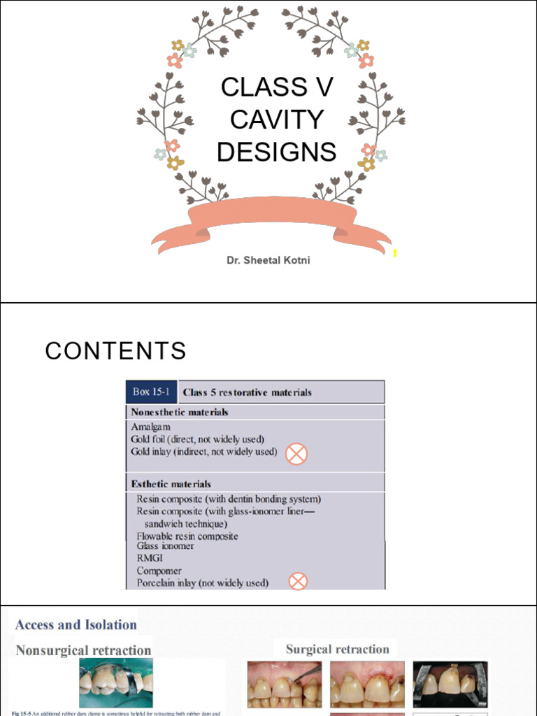 Class V Cavity Designs and Retention Grooves | PDF | Dental Composite ...