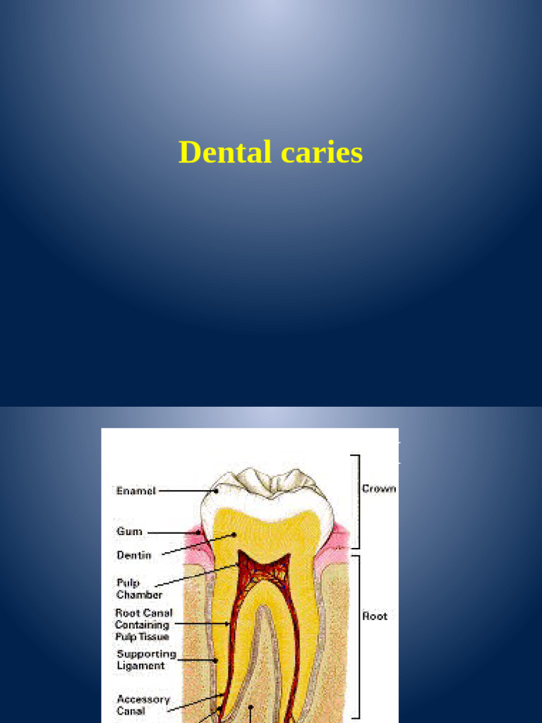 Dentin Caries in Class 1 Anteriors | PDF | Tooth Enamel | Tooth