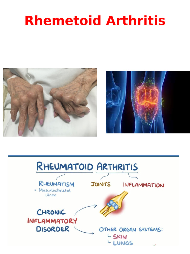 Understanding Rheumatoid Arthritis Symptoms | PDF