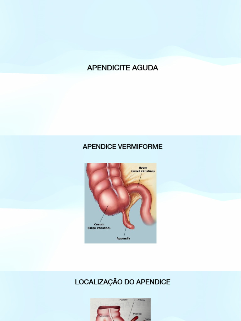 Sintomas e Sinais da Apendicite Aguda | PDF