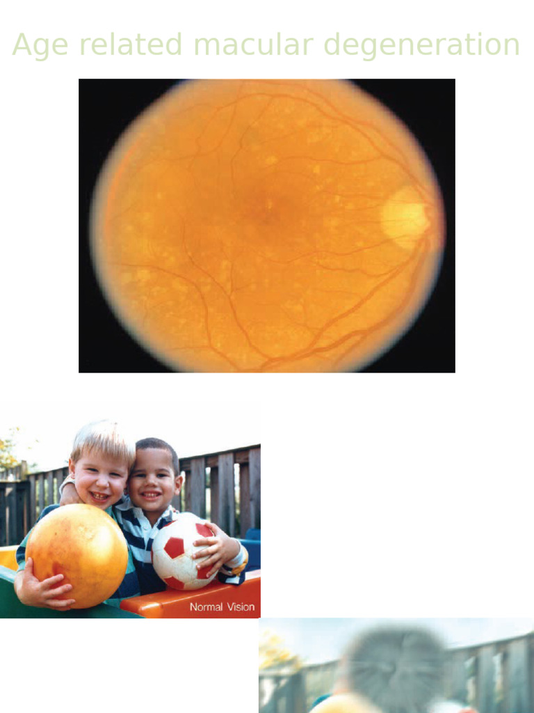 Age Related Macular Degeneration | PDF