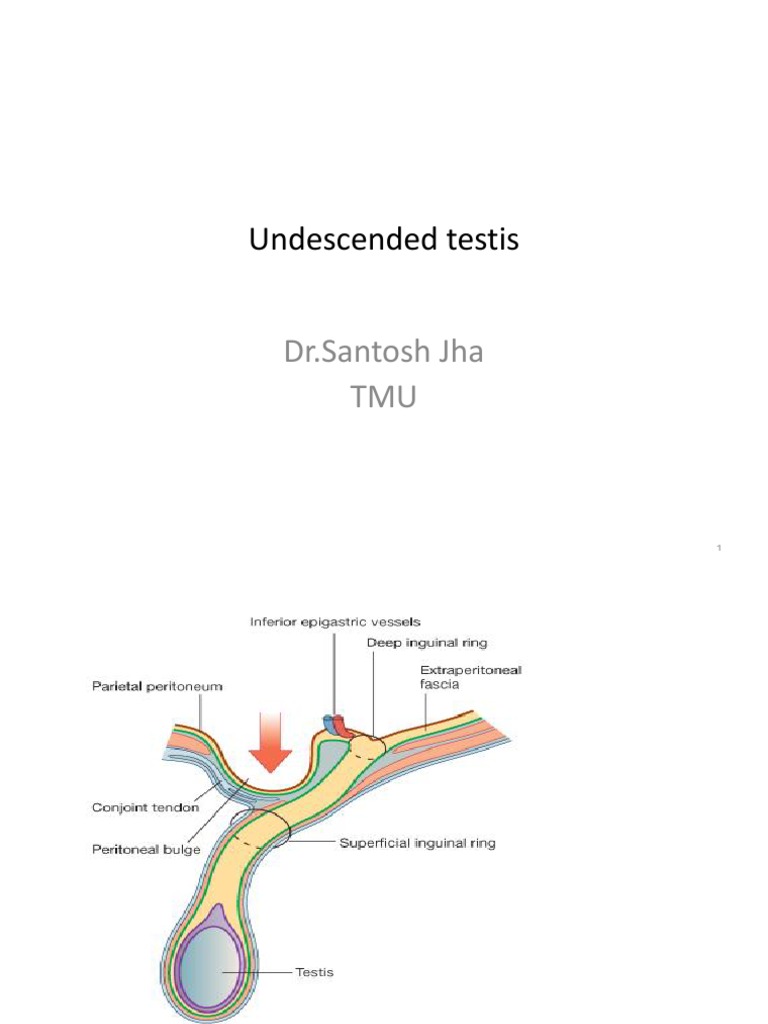 Undescended Testis Testicle Reproductive System