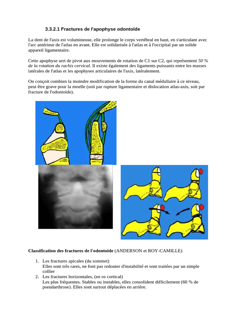 Classification des fractures de l'odontoïde | PDF | Appareil locomoteur ...