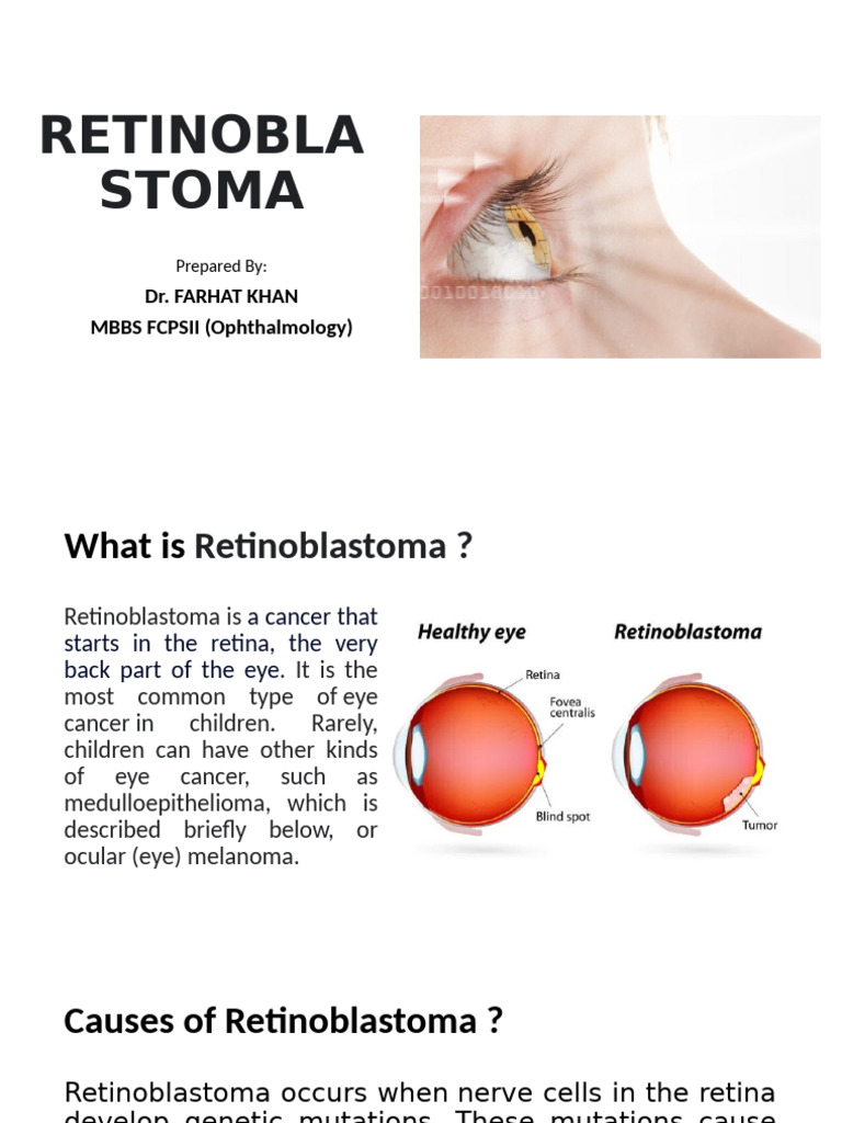 Understanding Retinoblastoma in Children | PDF | Chemotherapy | Cancer