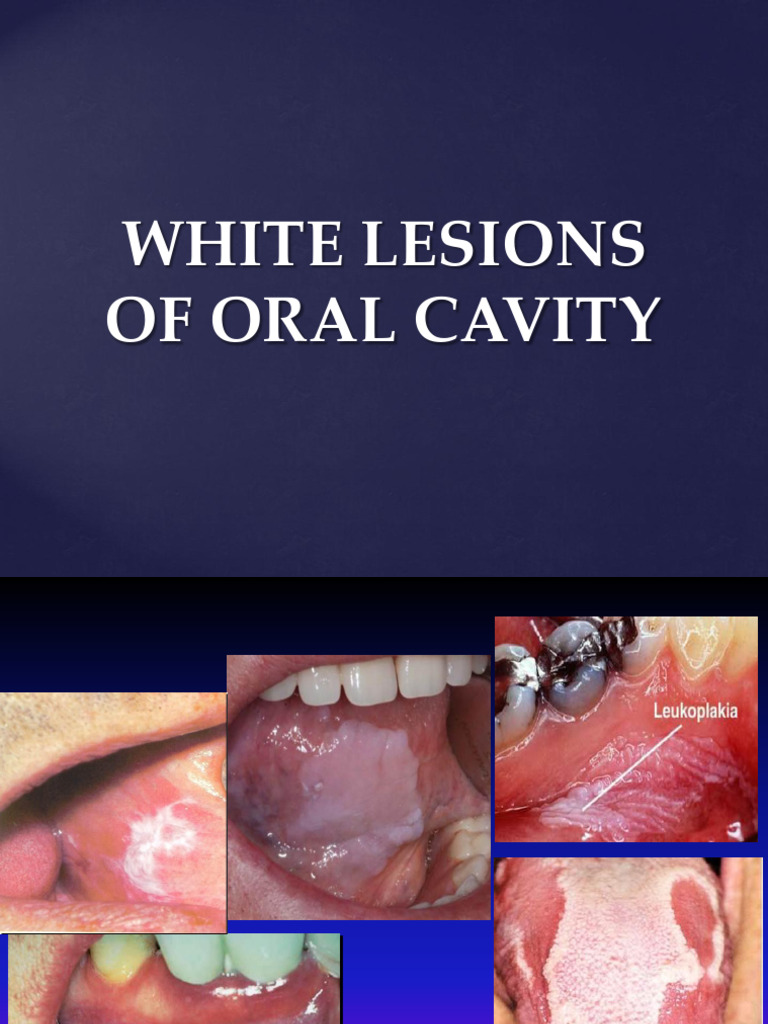 White Lesions of the Oral Cavity | PDF | Medical Specialties | Diseases ...