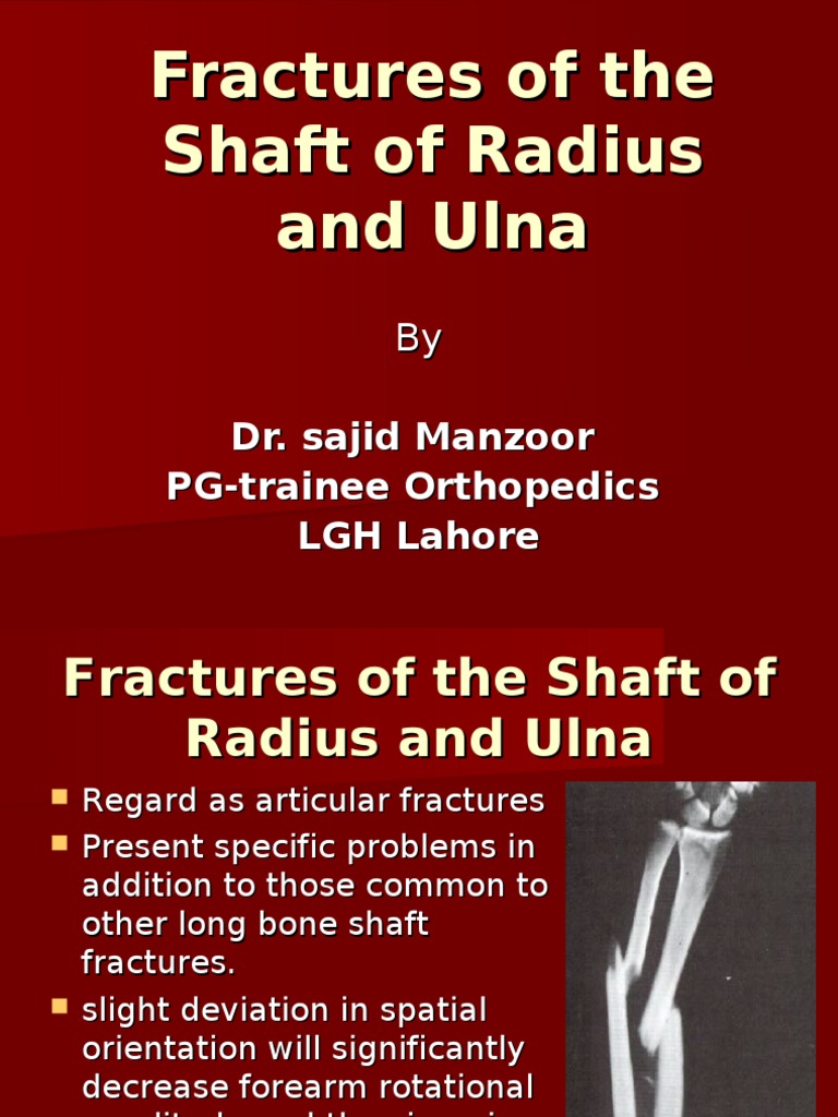 Fractures of The Shaft of Radius and Ulna | PDF | Limbs (Anatomy ...